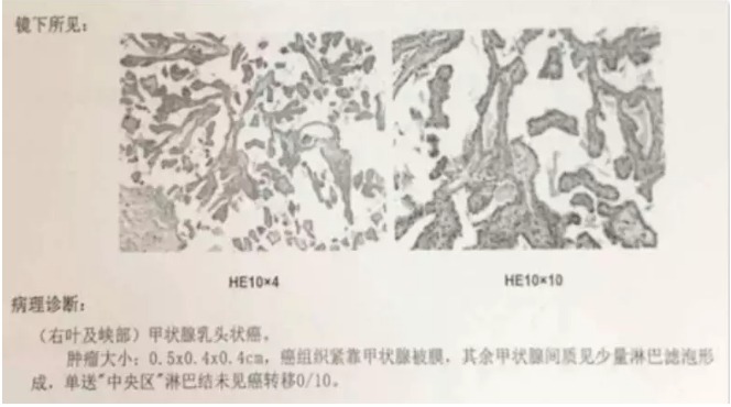 別慌，甲狀腺疾病還可以這樣投保！