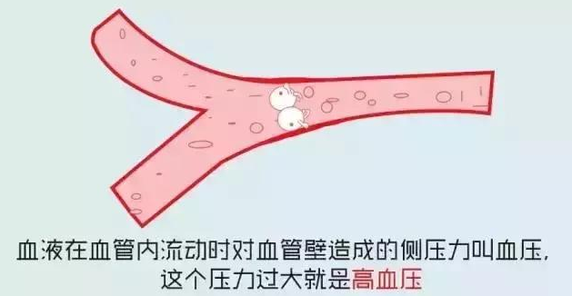 什麼是高血壓